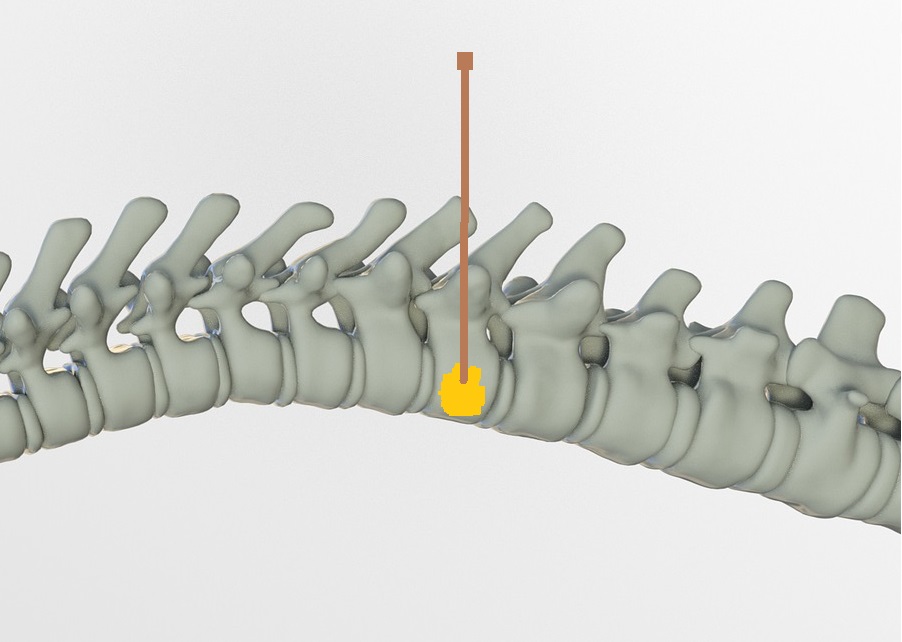 vertebroplasty kyphoplasty